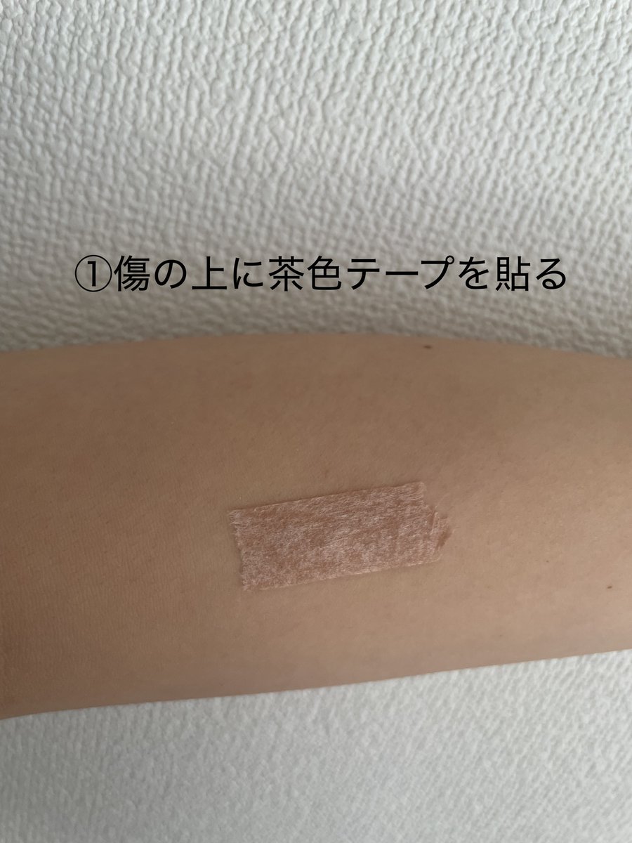 theclinic_jp's tweet photo. 【保存版】
脂肪吸引後の傷跡テープの貼り方💡

脂肪吸引後、
✔️抜糸までの約1週間はマイクロポアテープ（肌色テープ）と塗り薬
✔️施術から1ヶ月はマイクロポアテープ
を脂肪吸引の傷口に貼っていただきます❣️

💡テープと塗り薬の順番
①傷口の上に茶色テープを貼る
②テープの上から軟膏を塗布する

先に軟膏を塗ってテープをするとぬるぬるしてすぐに取れてしまします💦
テープの上からでもしっかりと成分は浸透しますのでご安心ください✨

脂肪吸引後の傷跡についてはこちら▼
https://t.co/nTMuNzSmYN