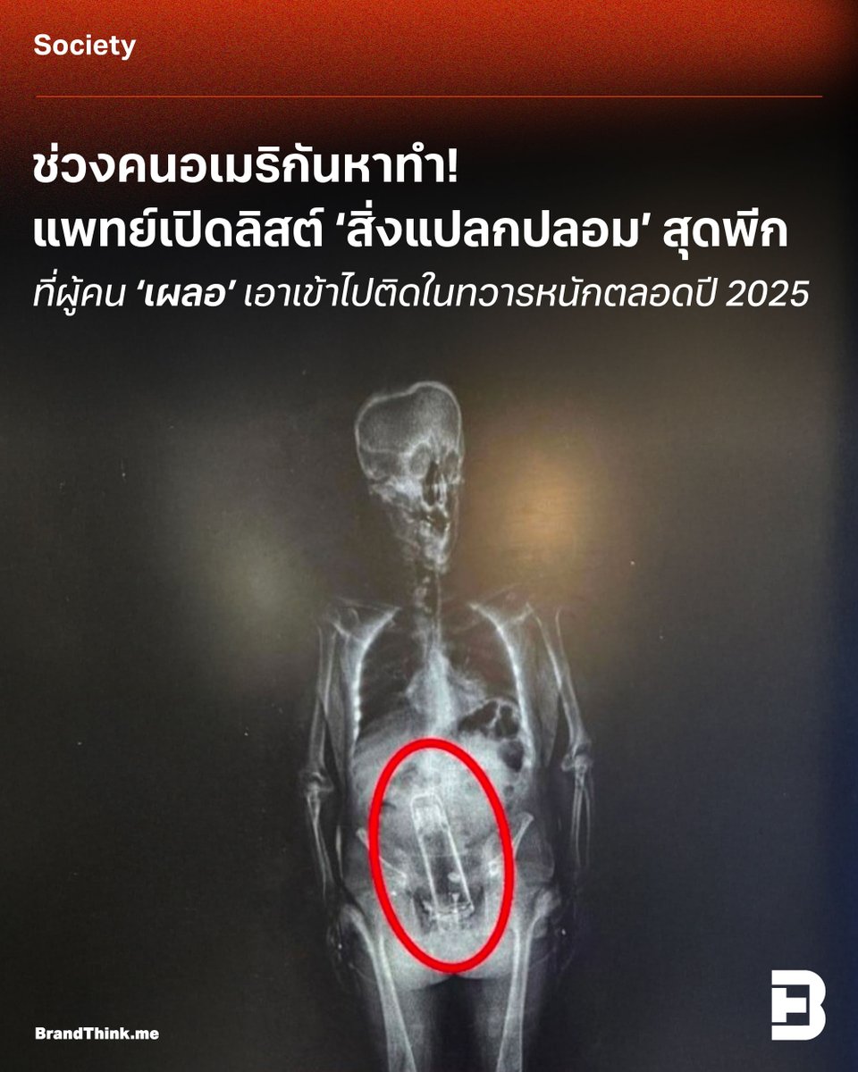 ช่วงคนอเมริกันหาทำ! แพทย์เปิดลิสต์ ‘สิ่งแปลกปลอม’ สุดพีก ที่ผู้คน ‘เผลอ’ เอาเข้าไปติดในทวารหนักตลอดปี 2025 

อ่านบทความได้ที่ : brandthink.me/content/foreig…