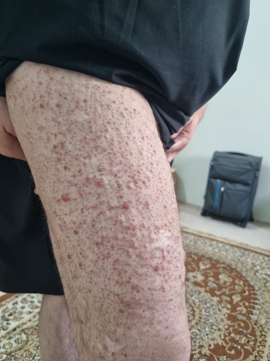 Ishaqsafdar76's tweet photo. I have been Suffering from a serious skin disease which is extremely painful and Incurable in Pakistan. Looking for help to be treated abroad. 
M.Ishaq Safdar. 00923109907770
@CSKPOfficial @CMShehbaz @GovernmentKP @GovtofPakistan @MaryamNSharif @ikhtiarwali @fkkundi @InsafPK https://t.co/mfMt4HIGW9