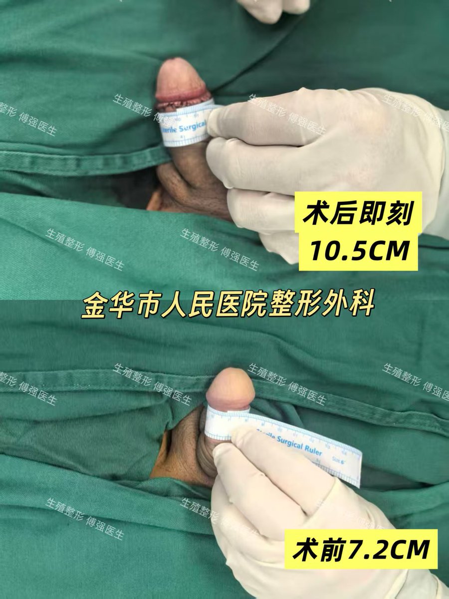 包皮阴茎增粗傅强医生 tweet media