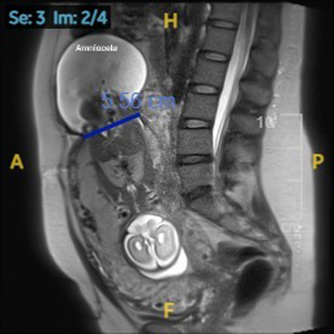 AJOG_thegray's tweet photo. AJOG Images in Obstetrics: Spontaneous uterine rupture at 23 weeks’ gestation after prior myomectomy - Sagittal T2-weighted magnetic resonance imaging showing the amniocele and fetal buttock protruding outside of the uterus https://t.co/bfcfN3ye6F https://t.co/OaASORGEfP