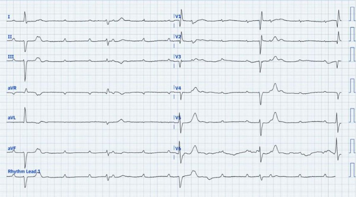 Heart_BMJ tweet media