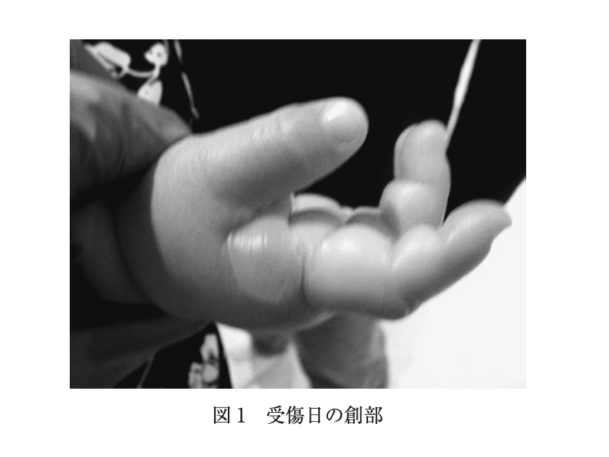 Dr_dog_ped's tweet photo. 日本小児科学会 Injury Alert
No. 152 炊飯器の蒸気による右手の熱傷

生後8か月で、最近つかまり立ちできようになった子
親が1分ほど目を離していたところ、異様な泣き声が聞こえ、熱傷が発覚

下記の写真の通り、ぱんぱんになっているが、その後皮が剥けてしまった…

子どもは興味津々で、炊飯器から出てくる湯気も触りたくなってしまうが、数秒で重いやけどを負ってしまう可能性がある

1秒も目を離さないというのは無理であるため、台所に柵を設けたり、子どもの手の届かない場所に炊飯器をおいたりなど、予防策が必須‼️

https://t.co/UMkxcWuYfI