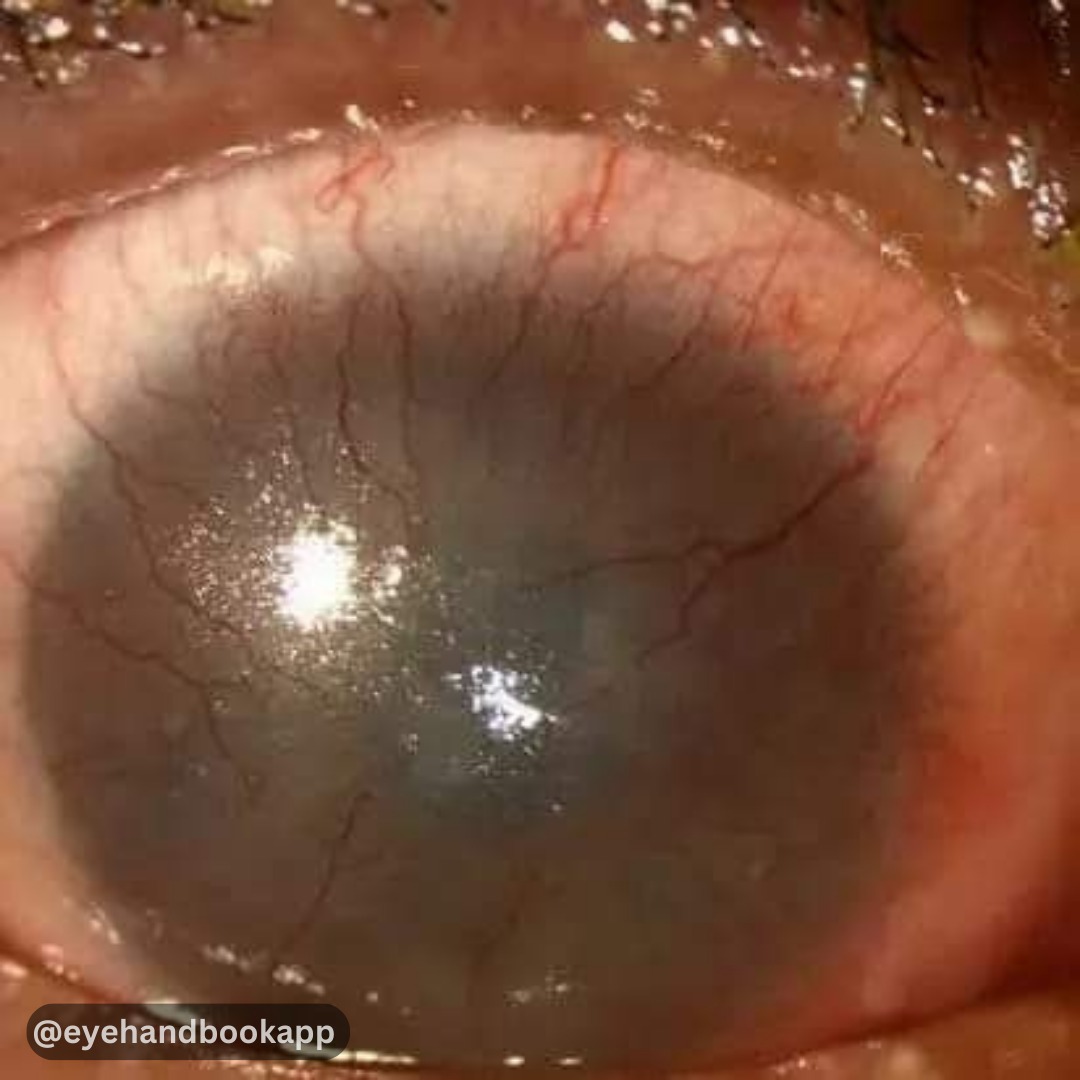 EyeHandbook's tweet photo. Comment on the diagnosis and suggest the best possible treatment.
#eyes #eyecare #eyesight #ophthalmology #optometry #ojos #cornea #retina #ophthalmologist #optometrist #ophthalmologyresidents #optometryresident #ophthalmologylife #eyehealth #oftalmologia #eyedoctor https://t.co/icaPBC9pMy