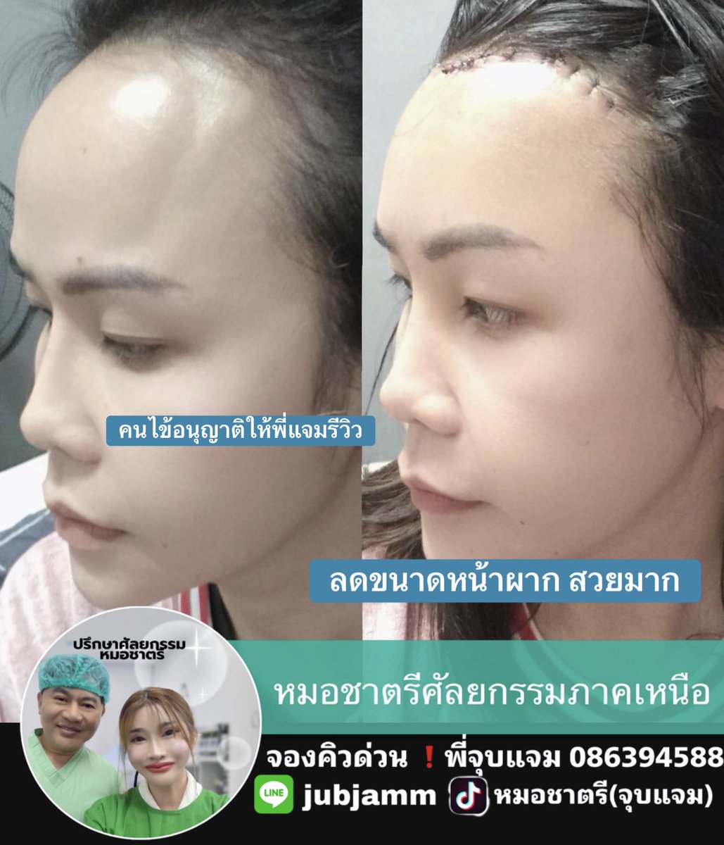 O2MUgkaZ1sfpmWa's tweet photo. #ลดขนาดหน้าผากหมอชาตรี https://t.co/FRMTxe2Iry