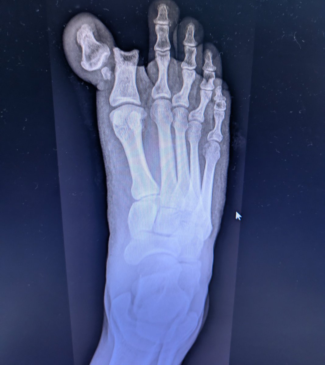 Christmas Day in ED:
A gentleman, festive spirits, commando roll, and one dislocated toe.

Definitely a mistoe-ltoe moment 🎄

Merry Christmas all — enjoy the festivities, but maybe skip the stunts.
<a href="/EM_RESUS/">Sam Ghali, M.D.</a>