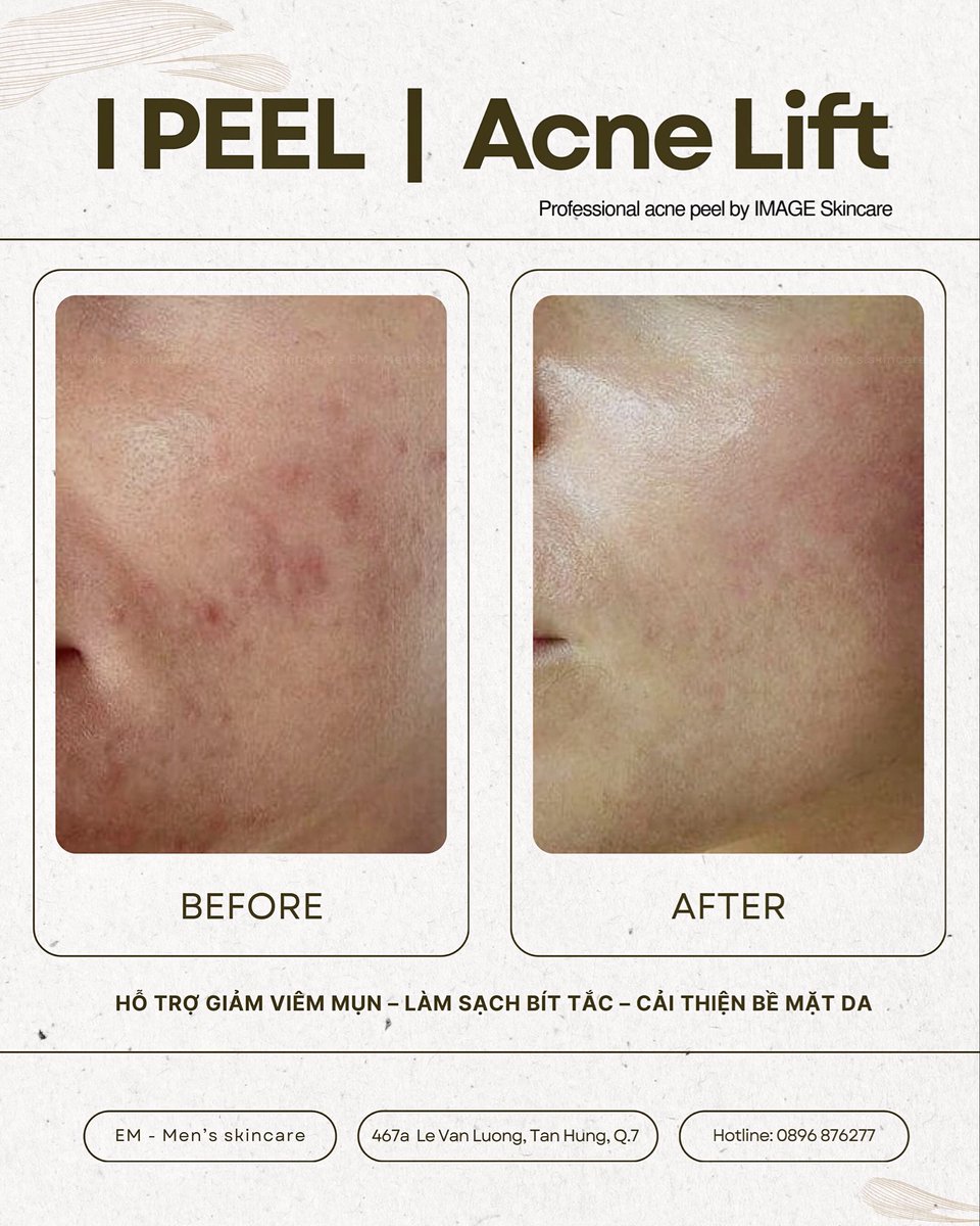 EmTheminispa's tweet photo. LIỆU TRÌNH 1 LẦN PEEL MỤN NHẸ VỚI I PEEL | ACNE LIFT 
📍 I PEEL |  Acne Lift là peel mụn nhẹ ứng dụng phức hợp AHA–BHA và enzyme sinh học, tối ưu cho da nam dễ dày sừng, bí tắc, mụn...
☎️ 0896 876277 https://t.co/4IM6bLfyJv