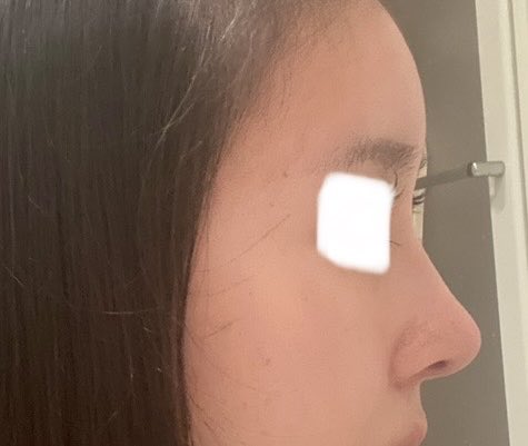 datusunako's tweet photo. 鼻2ヶ月目経過👃
1枚目の1ヶ月経過に比べたら鼻先が降りてきてより自然になってきた😌🤍 https://t.co/BPVYhBTZN8