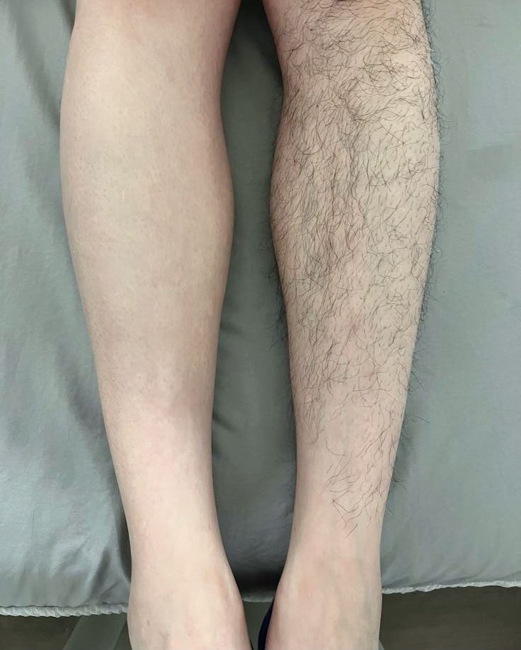 #蜜蠟脫毛 #waxing 
清爽感🫧有意請WHATSAPP96518168