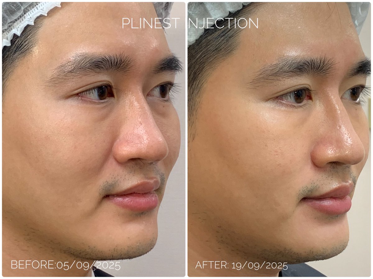 grumpyteddyy's tweet image. วันนี้โบมาอัพเดทหัตถการงานฉีด 💉ที่ช่วยฟื้นฟูผิวบริเวณร่องแก้มซึ่งสำหรับโบโบเห็นการเปลี่ยนแปลงชัดเจนสุดๆ*

ซี่งโปรแกรมที่โบทำเรียกว่าโปรแกรม Plinest 🐟 ครับ**

*ผลลัพธ์ขึ้นอยู่กับแต่ละบุคคล
**ดูแลโดย พญ.กุหลาบ จิตต์มิตรภาพ ว.9144 aes class clinic สาขาชิดลม