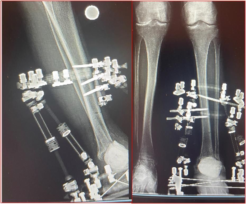 MoAImam's tweet image. "Local Antibiotic Delivery Systems and Their Applications in Orthopaedic Surgery" by Hoveidaei et al. 

Read the full article bit.ly/474uMAG 

#infection