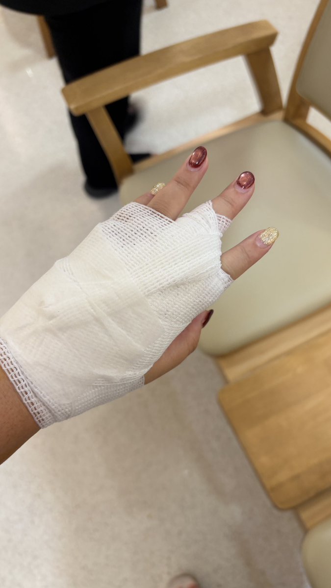 tkapo_'s tweet image. อยากลงไว้เป็นเรื่องเล่า/อุทาหรณ์ ว่าแมวกัดมันไปสู่ผ่าตัดมือได้ยังไง 😭

เริ่มจากนี่โดนแมวกัดจมเขี้ยว 4 รูที่นิ้วกลางและโคนนิ้ว เลยรีบไปรพ.ทันที วันแรกล้างแผลแล้วกลับบ้าน ฉีดวัคซีนตามปกติ วันที่ 2 ก็ยังไปล้างแผลอยู่ แต่หมอเจอความผิดปกติในวันที่ 3 ว่าแผลบวมไม่ยุบ มีหนอง