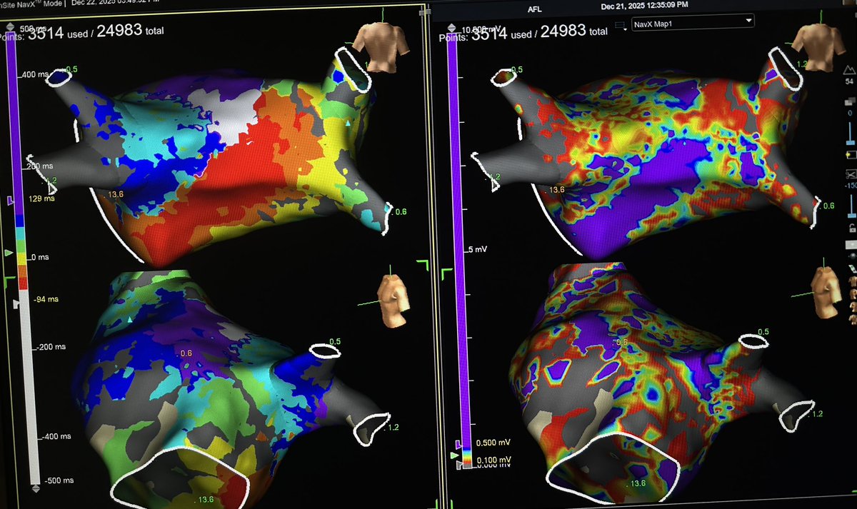 javadm20's tweet photo. EP is beautiful! Atypical flutter in a pt.with hx. of mechanical MVR! Gradual lengthening and termination at this 👇corridor with nice diastolic buffet! #Epeeps https://t.co/ZbrUuLKi6q