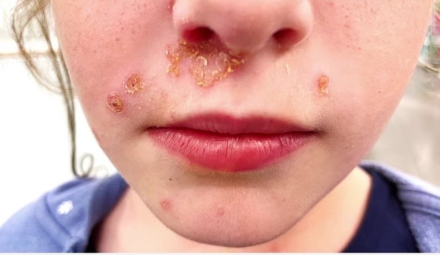 What is the most likely cause❓

A. Streptococcus Pyogenes
B. Staphylococcus Aureus
C. Herpes Simplex Virus
D. Malassezia Furfur