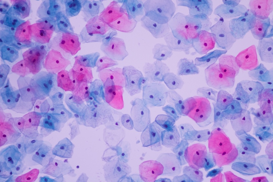 ProfSirera's tweet photo. The stained smears of the female reproductive tract possess a quiet, unexpected beauty. Under the microscope, layers of colour unfold with an almost abstract elegance: blues, pinks, and amber tones arranged in cellular geometries that could have inspired Kandinsky himself. 

🌟 Yet this visual poetry is not mere aesthetics. It marks one of the greatest achievements in modern medicine—the prevention of a deadly female cancer—made possible by scientific devotion, patience, and the extraordinary partnership of a couple. 

🚩 In this post, I am presenting one of the major milestones of twentieth-century medicine, comparable to antibiotics and vaccines in terms of lives saved: the Papanicolaou test, or cervical cytology. Simple, minimally invasive, painless, and inexpensive, it has transformed women’s health and public health policy worldwide. The Pap test is not just a medical procedure; it is a story of science, love, and perseverance that has saved millions of women’s lives.

▶️ The history behind
In 1913, a young Greek physician, George Papanicolaou, arrived in the United States aged 30, carrying little more than 250 dollars and accompanied by his wife, Mary Papanicolaou, who would become his inseparable partner in life and in the laboratory.

George aspired to be a scientist, despite his father’s wish that he become a surgeon. In New York, he survived on whatever work he could find, even playing the violin in restaurants, until he eventually secured a position at Cornell University. There, he began to study cells.

In 1928, after examining a cervical sample, he observed something remarkable: cells showing malignant changes. Cervical cytology had been born. Yet the medical community dismissed his findings, and his work was largely ignored.

Mary never allowed him to give up. For more than twenty years, she underwent daily sampling, assisted in every experiment, and sustained him during moments of doubt. She was simultaneously his muse, his technician, and his emotional anchor.

By the 1940s, the “Pap test” began to gain acceptance. Medical associations and women’s health advocates broke longstanding taboos surrounding vaginal smears. The impact was profound: mortality from cervical cancer fell by over 70% within a few decades.

Today, the World Health Organization considers cervical cancer a disease that could be eliminated this century through HPV vaccination combined with systematic screening.

▶️ The biological perspective
The cervix is a dynamic tissue. Its epithelium constantly renews itself, shedding cells into the vaginal lumen. Persistent infection with high-risk human papillomavirus induces characteristic morphological changes: koilocytosis, dysplasia, nuclear enlargement, and chromatin irregularities.

The Pap test relies on a sophisticated interplay of stains that reveal nuclear architecture (haematoxylin) and cytoplasmic maturation (Orange G and eosin-azure). Interpretation requires contextual knowledge of the menstrual cycle, which enhances both sensitivity and specificity.

Through these stains, the cytologist can distinguish superficial, intermediate, and basal squamous cells; metaplastic and endocervical cells; and the hallmarks of premalignant and malignant transformation, including altered nuclear-to-cytoplasmic ratios and pleomorphism. Lesions typically progress along a continuum from low-grade intraepithelial changes to high-grade lesions, carcinoma in situ, and finally invasive cancer.

Importantly, cervical epithelium is hormonally responsive. Fluctuations in oestrogen and progesterone shape the cellular composition of the smear, allowing cytology to serve as a readout of the vaginal maturation index, a classic tool in gynaecological endocrinology. Deviations from expected cellular patterns may suggest endocrine disorders, atrophy, chronic inflammation, or intraepithelial neoplasia.

▶️ The power of the Pap test lies in time. 
It exploits the long window—often years—between initial HPV infection and invasive cancer, making early detection both effective and economical. It stands as a paradigm of preventive medicine and a gateway to broader sexual health interventions, including education and STI prevention.

Today, cytology is increasingly complemented by molecular HPV testing, allowing longer screening intervals when results are negative. However, access remains uneven. In low-resource settings, limited screening coverage continues to translate into preventable deaths, highlighting a persistent global challenge in health equity.