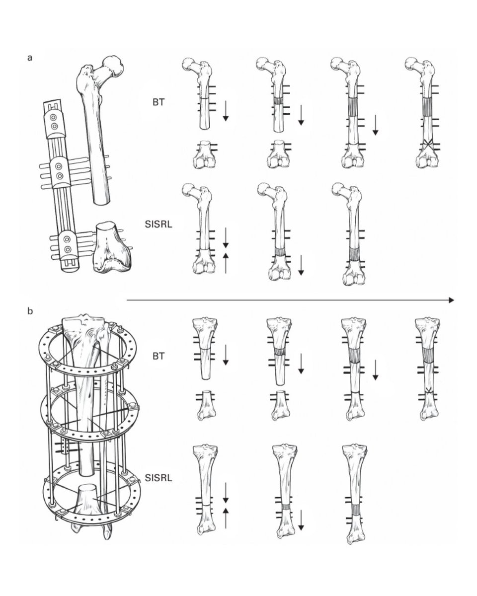 BoneJointJ's tweet photo. Compared with conventional bone transport, the shortening and in situ relengthening technique may offer distinct advantages when addressing defects in the metaphyseal region.

#IlizarovTechnique #Bone #Surgery #BJJ

https://t.co/AMgkDQOIi2 https://t.co/JwtzXalpP6