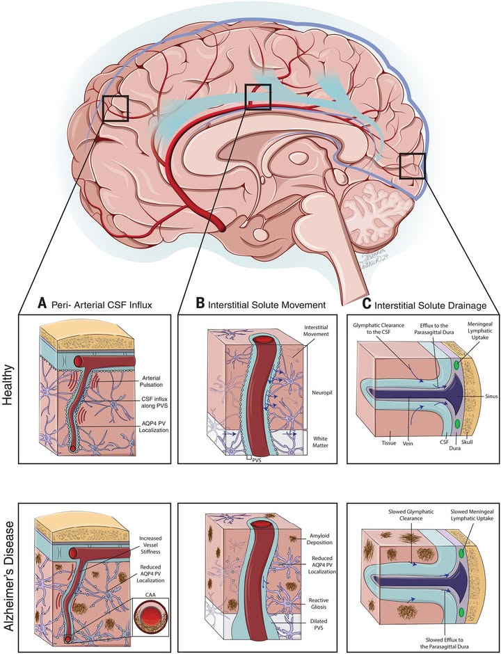 ScienceMagazine's tweet image. In a #ScienceReview from earlier this year, researchers provide a critical evaluation of research linking glymphatic dysfunction with Alzheimer’s disease. 

Learn more: scim.ag/3UoVNaK