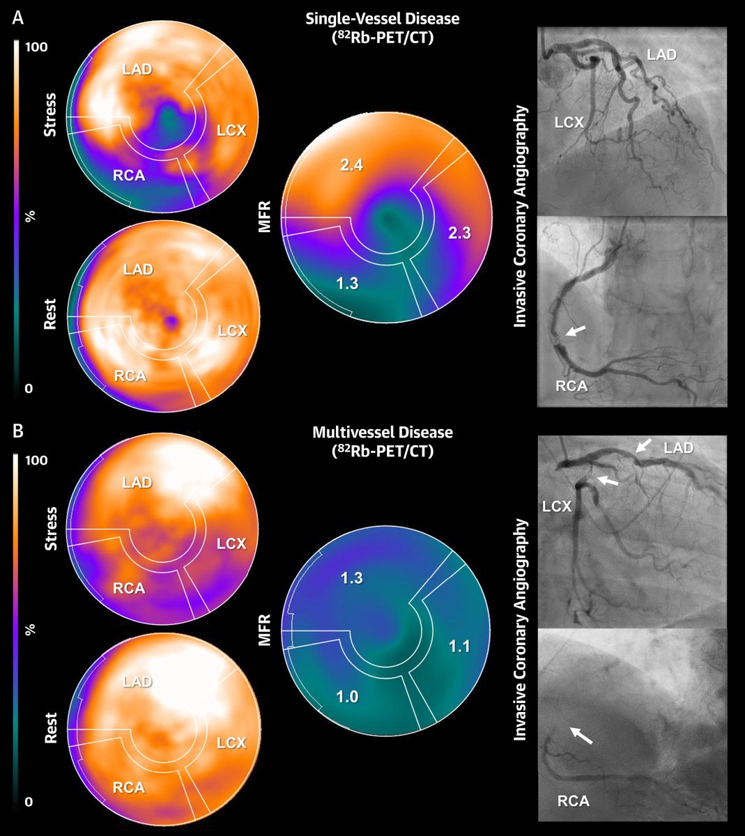 JACCJournals's tweet photo. Severely reduced MFR in #ThinkPET is a diagnostic challenge. 🫀☢️ This #JACCIMG #iPIX lays out the full differential—from 3-vessel CAD to artifacts—to spot the patterns, avoid the pitfalls, and not miss the diagnosis. https://t.co/MYQ7iVebMA #cvCAD @domcbenz https://t.co/dqlPBir3Ve