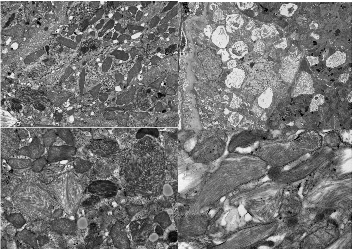 grace_choung's tweet photo. Kappa-type light chain proximal tubulopathy
On EM, low mag shows membrane-bound crystalline-like cytoplasmic inclusions but up close has fibrillar appearance.
🔹Congo-red is negative
🔹Reported w/ MGUS, MM, & lymphoma
🔹Most had fanconi syndrome
#MGRS #renalpath https://t.co/E5HxG20191