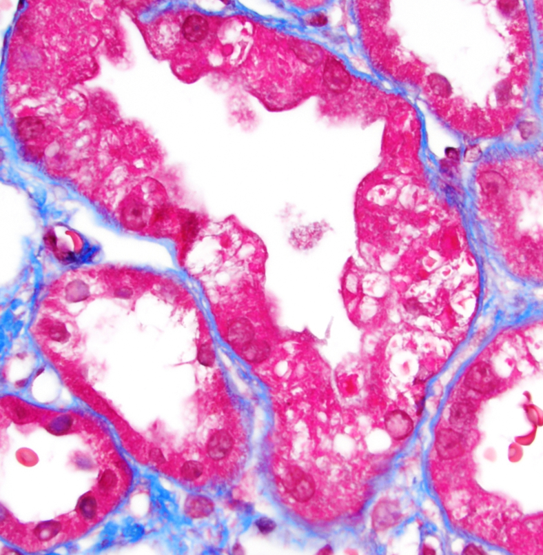 grace_choung's tweet photo. Kappa-type light chain proximal tubulopathy
On EM, low mag shows membrane-bound crystalline-like cytoplasmic inclusions but up close has fibrillar appearance.
🔹Congo-red is negative
🔹Reported w/ MGUS, MM, & lymphoma
🔹Most had fanconi syndrome
#MGRS #renalpath https://t.co/E5HxG20191