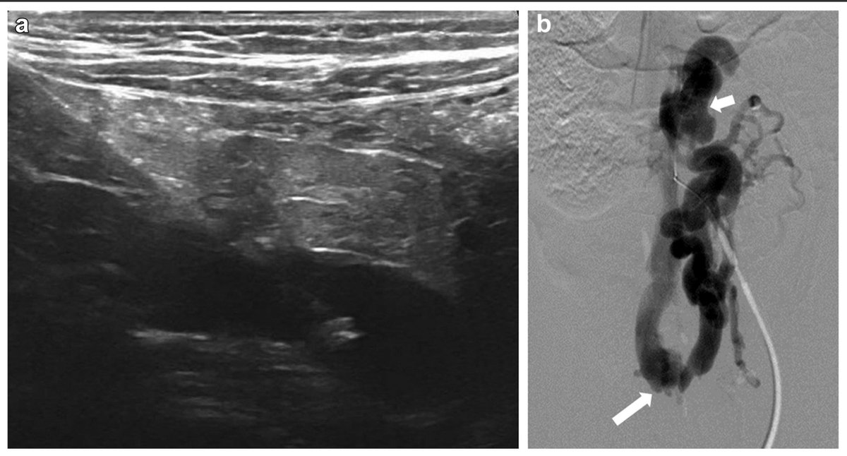 JVS - Venous and Lymphatic Disorders tweet media