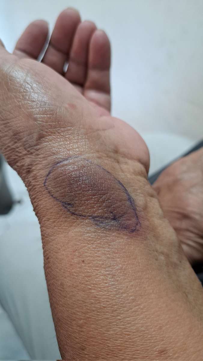 Estoy en el hospital Fernando Ocaranza <a href="/ISSSTE_mx/">ISSSTE</a> de #Hermosillo con mi mamá, le picó una araña, trae síntomas de intoxicación, tenemos más de 1 hora en urgencias y ni siquiera le han tomado signos... <a href="/Claudiashein/">Claudia Sheinbaum Pardo</a> <a href="/AlfonsoDurazo/">Alfonso Durazo</a> urge atención Al sistema de salud