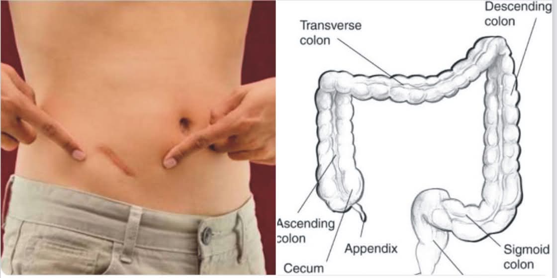 بسم اللہ الرحمن الرحیم
 بعض اوقات پیٹ کے دائیں جانب (اپینڈکس کے مقام پر) درد ہوتا ہے جس سے آدمی ڈر جاتا ہے کہ کہیں یہ اپینڈکس کا درد نہ ہو ۔
حقیقت یہ ہے کہ خشکی کی وجہ سے بڑی آنت( colon)میں مواد خشک اور سخت ہو جاتا ہےاور دوسرا یہ کہ اپینڈکس کے مقام پر بڑی آنت سیدھا اوپر کی طرف