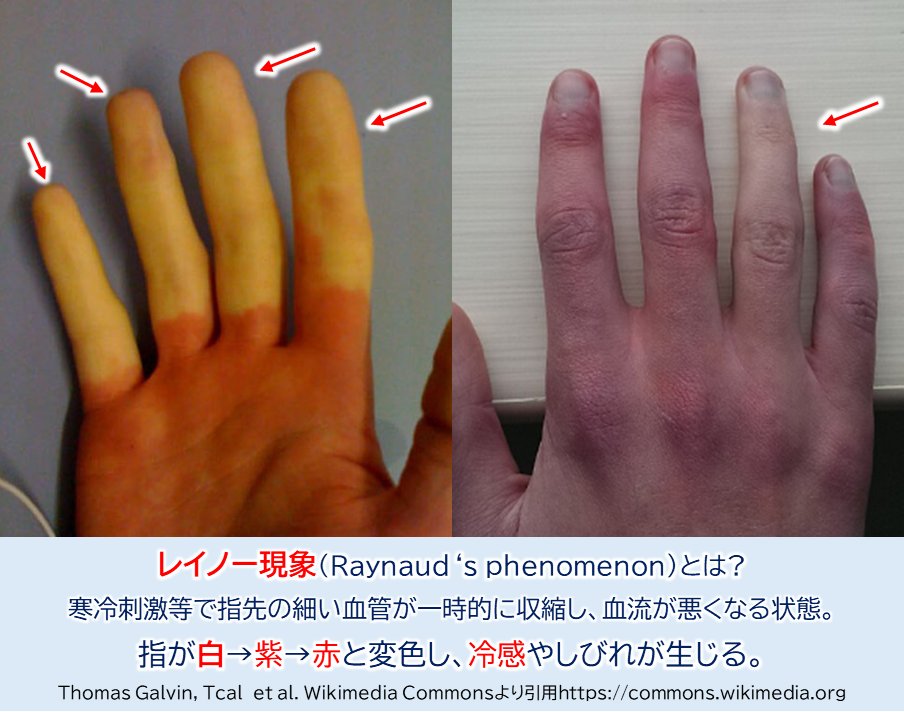 呼吸器内科医「指先が白くなってますね。
これはレイノー現象ですよ」  

患者「……霊能現象ですか？」

医「はい、レイノー現象（Raynaud's phenomenon）です。有名な所見ですよ。
ところで冷感はありますか？」

患「え？ 霊感ですか？ 私にはないです。
先生には霊感あるんですか？」 

医「ん？