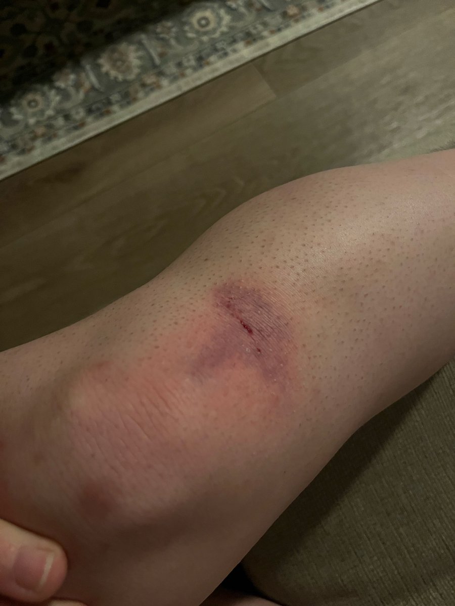 Meg_nificent93's tweet photo. @elonmusk @Tesla I fell walking up the stairs and busted my leg, but the bruise is in the shape of the Tesla logo. Do you think I can work out some kind of brand deal?

Also I’m getting married in a few weeks so I’d settle for a borrowing a getaway car for post-ceremony. Thanks! https://t.co/OsmhPbQKXH
