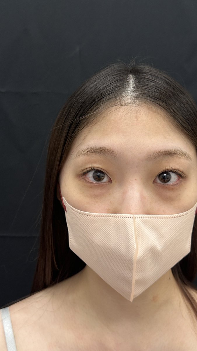 dr_yokose's tweet photo. #ルラ美容クリニック 
#ルラ美容クリニック郡山院 

脱脂注入。

よかれと思ってチークを高くしすぎると、
ゴルゴの靭帯がより強く見える…という現象が起きます。

定着を考えると、どれくらい入れようか…

ある意味、裏ハムの方が安定した結果という意味で簡単なのかも。 https://t.co/aFvyB5FSsa