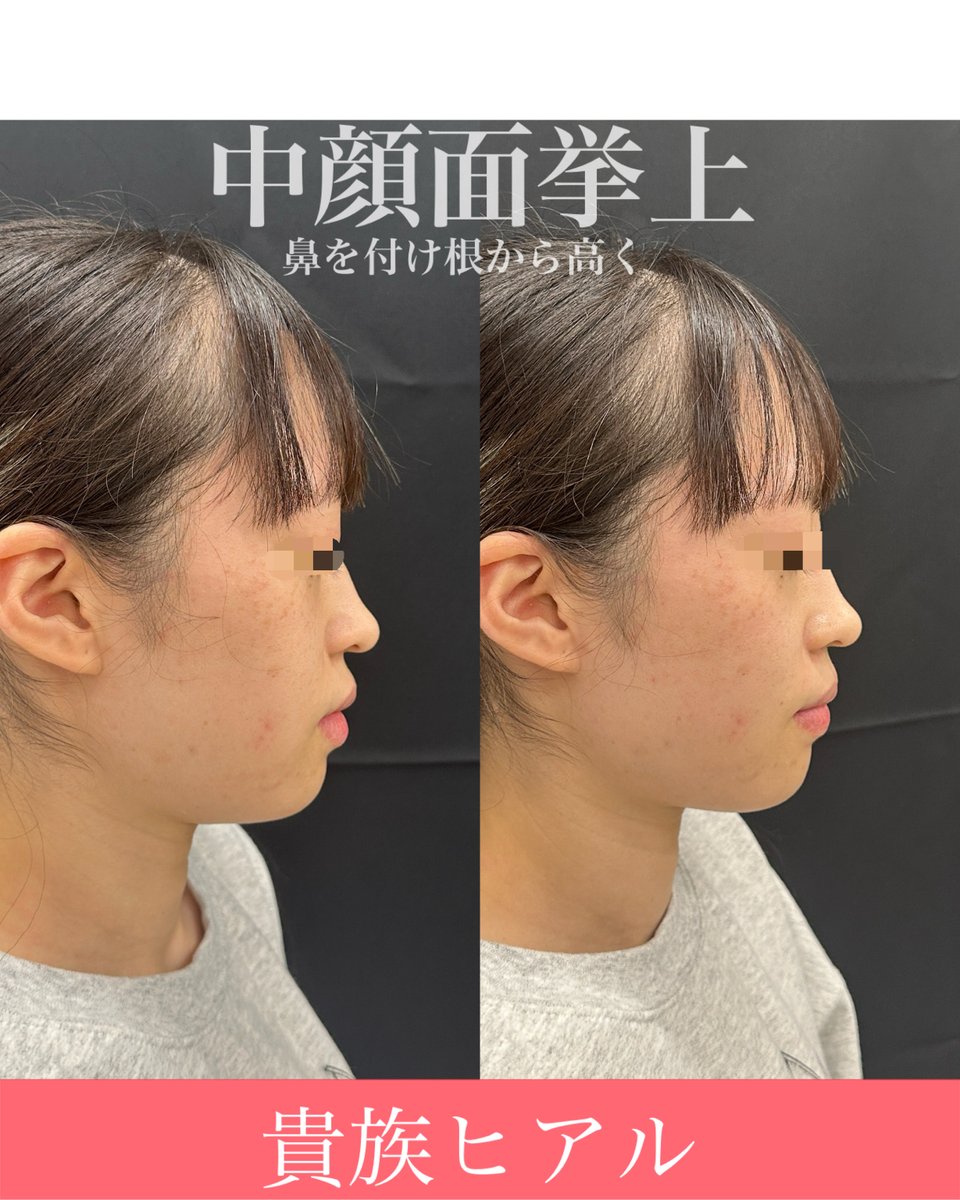 dr_yokose's tweet photo. #ルラ美容クリニック 
#ルラ美容クリニック郡山院 

貴族フィラー。

鼻の下に敷き込むと横顔が変わる。

ほうれい線ヒアルとの最大の違いです。 https://t.co/36UFx8aauq