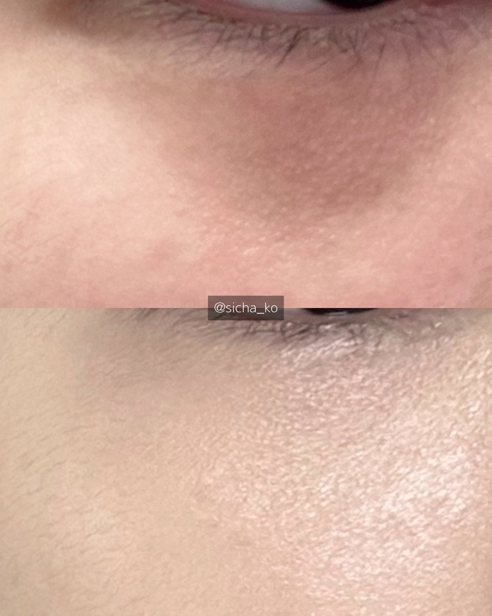 sicha_ko's tweet image. 5분컷 하이라이터로 다크서클 완벽 커버하는 법 알려드림

*하이라이터의 반사광을 이용하는 방법이라 푸르스름하거나 보랏빛 다크서클보다 눈물고랑 때문에 색소침착처럼 어두운 다크서클에 훨씬 더 효과가 좋습니다✨