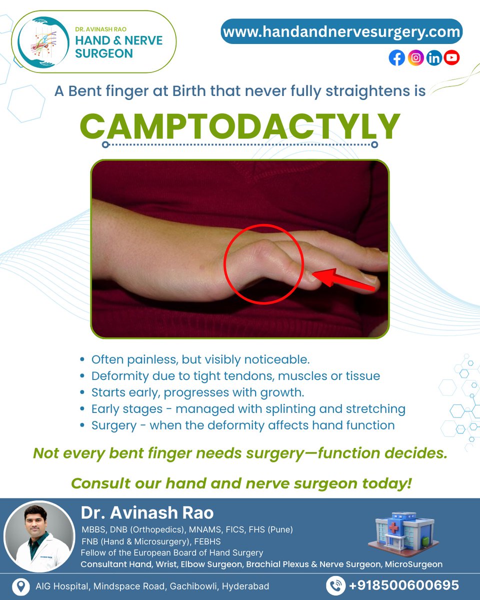 HandSurgeon01's tweet photo. When fingers don’t fully straighten, awareness helps. Camptodactyly causes permanent finger bending, often from childhood. #Camptodactyly #HandHealth #Orthopedics #ReconstructiveSurgery #Microsurgery #AdvancedSurgery #DrAvinashRao
Call: +91-85006 00695 https://t.co/iiLuCFhAWO https://t.co/B4uXnjLHcb