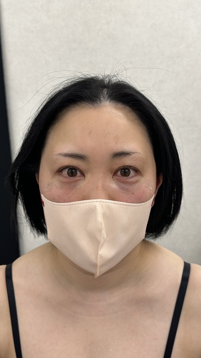 dr_yokose's tweet photo. #ルラ美容クリニック 
#ルラ美容クリニック郡山院 

脱脂注入。
年末クマ取り多いです。

内ガン角＝蒙古襞のあたりも
少ーしいれると目元がふっくら。 https://t.co/NWMXiAinVb
