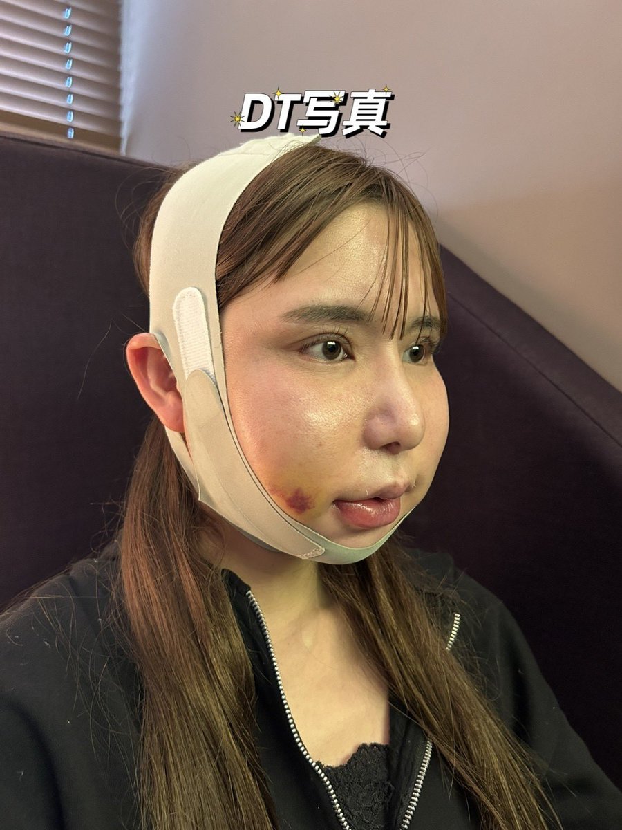 _dollchan's tweet photo. 韓国のギリン美容外科で両顎、輪郭3点をユン院長にしていただきました！
すごく対応が丁寧で素早く安心しています。なによりサービスなどがよく安心して手術を受けれたことに感謝しています✨

＃ギリン美容外科　#輪郭３点　#両顎 https://t.co/3K7yzx5LLO