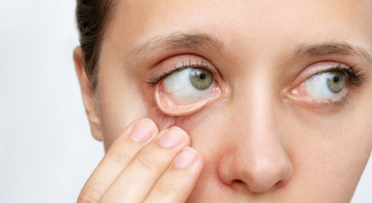 ودع الحرقان.. أفضل علاج لجفاف العين بدون أدوية في المنزل 
