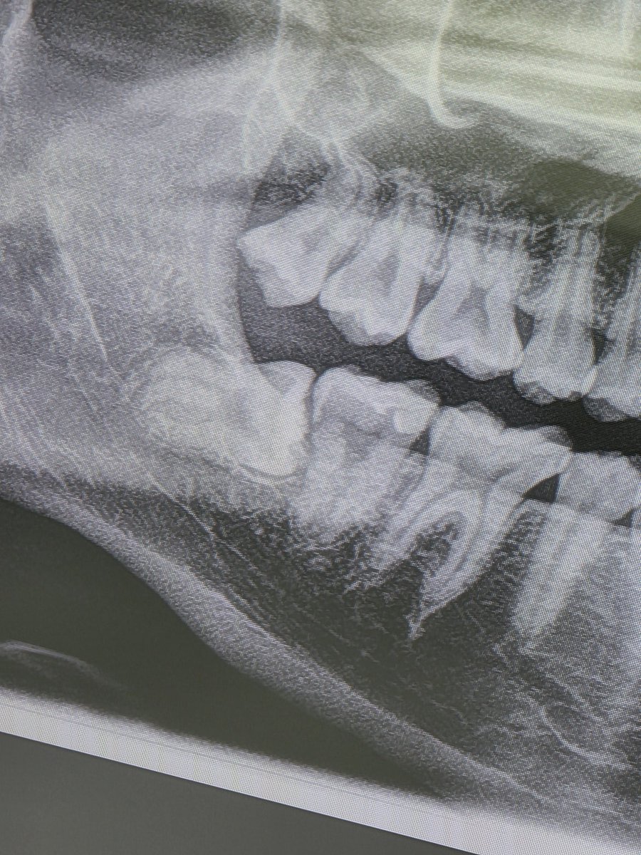 skywongraveee's tweet image. เอาใหม่ ไม่ใช่ 3 ปี อะแฮ่ม 6 ปี ! ตลอดหกปีที่กูไม่เคยทำร้ายใคร แต่ว่าวันนี้กูจะเอามึงออกไป  มึงจะต้องเจ็บ มากกว่าที่ทำเหงือกกูเจ็บ ไอฟันคุดที่นอน 180 องศา ตุ้บตั้บๆ (เสียงเครื่องมือแพทย์)