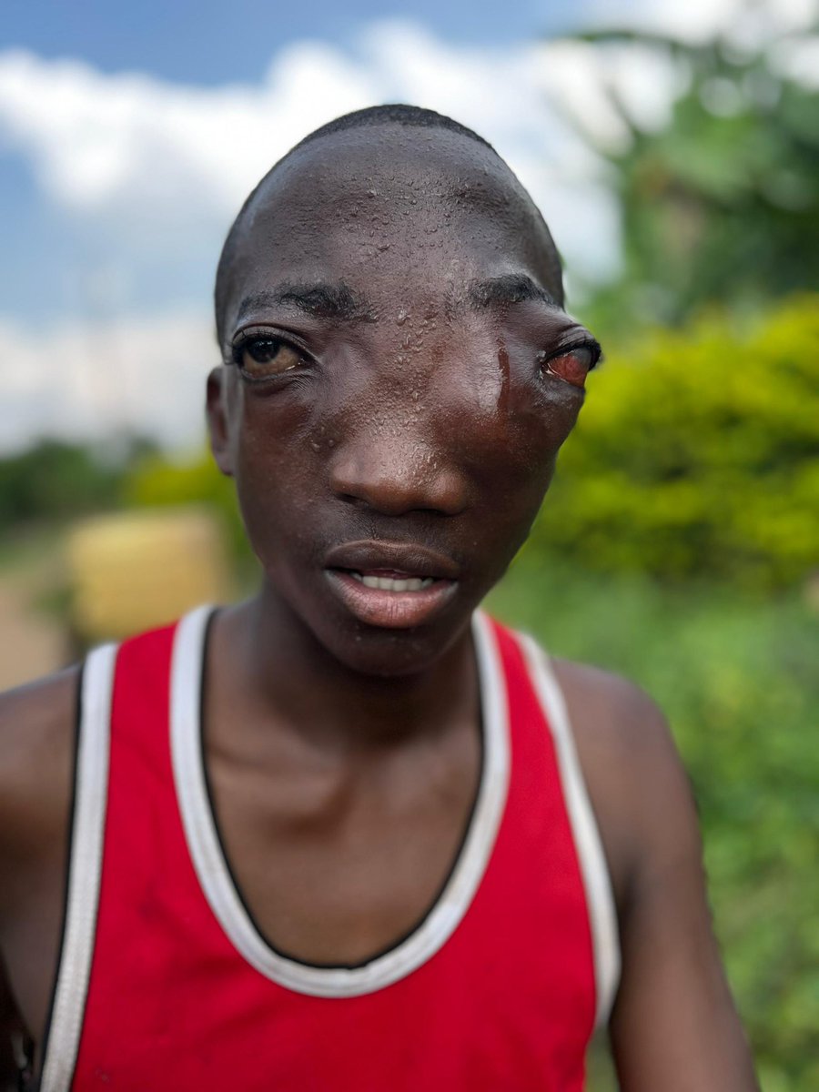 UgandaCentered's tweet photo. As I was moving within the community, I found this innocent soul 💔 His eyes are swollen and almost bulging out. My heart is heavy. No child should suffer like this. Please keep him in your prayers 🙏🏽🤍 #InnocentLives #CommunityOutreach #PrayForChildren #LoveInAction https://t.co/CW8GfjFKrS