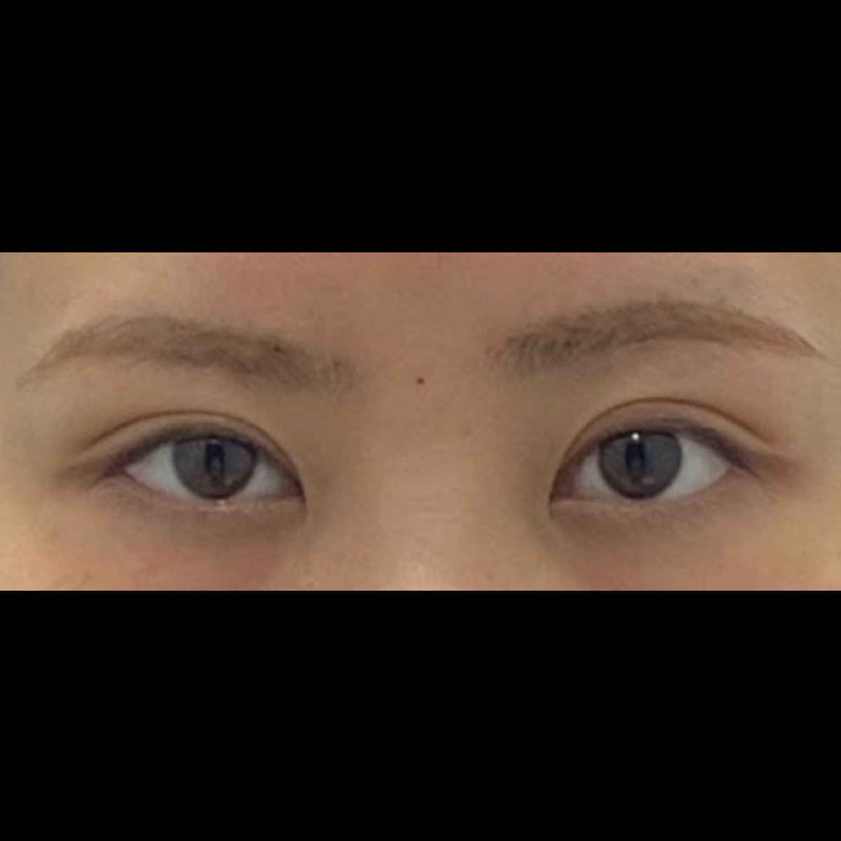 mi_woo28's tweet photo. フルリュン美容外科で施術した涙袋ヒアル、理想の涙袋になって大満足です🙆‍♀️✨️
カウンセリングも施術も丁寧で本当にやって良かったです💞 https://t.co/cS8GyIRsPw