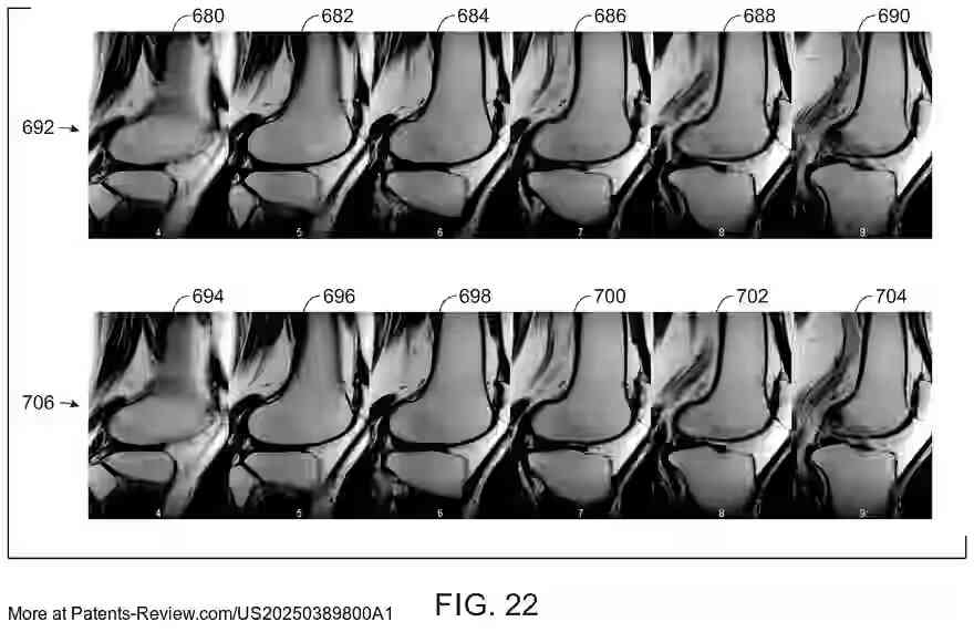 PatentPulse's tweet photo. New patent application #US20250389800A1 by #GEPH (GE Precision Healthcare) introduces a #ModelBased #DeepLearning method for denoising #MRI images.
The system uses a processing system to obtain noisy k-space data and employs a deep learning-based mask estimating model to create a data consistency mask.
This mask aids in denoising the data, enhancing image reconstruction.
#Healthcare #AI