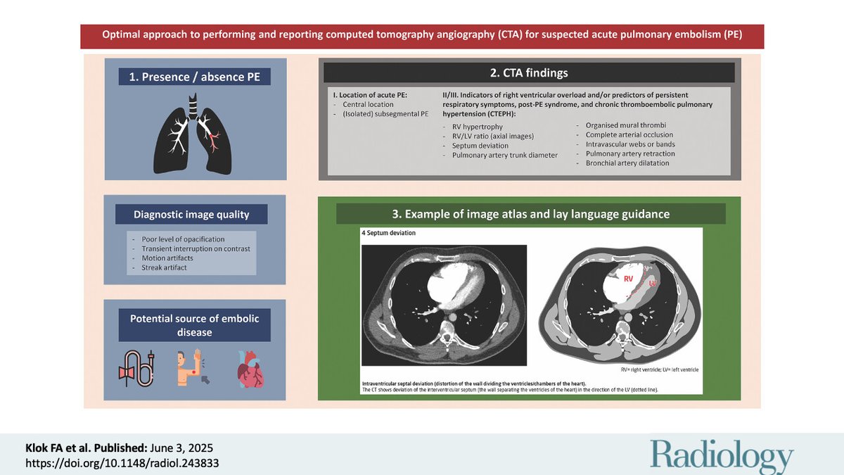radiology_rsna's tweet image. As 2025 draws to a close, we're counting down the top 5 Radiology articles of the year by number of views! At no. 5️⃣ is the statement published in conjunction with @escardio and the Fleischner Society on CTA for suspected acute pulmonary embolism: bit.ly/45CzViP
