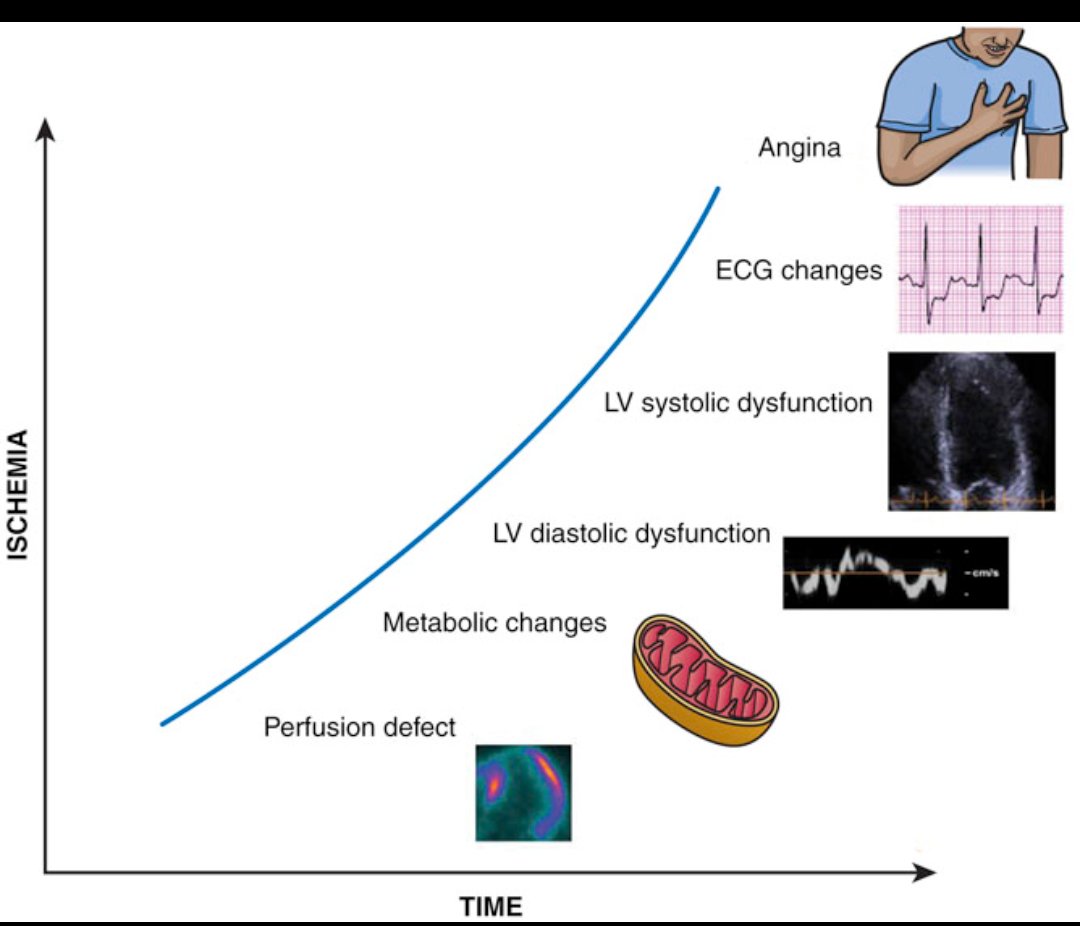 TrackYourHeart's tweet photo. The Ischemic Cascade; why ischemia whispers before it screams
Myocardial ischemia is a process, not an instant event. Long before a patient feels chest pain, the heart is already struggling.
It begins with reduced regional myocardial perfusion, creating a mismatch between oxygen supply and demand. At the cellular level, metabolism shifts as mitochondria fail to meet energy needs. Only later do we see LV diastolic dysfunction, followed by systolic dysfunction, ECG changes, and finally the symptom patients recognize, angina.
This sequence explains a common clinical pitfall: waiting for chest pain or ECG changes means we are detecting ischemia late.
That’s why stress testing with myocardial perfusion imaging is more sensitive than approaches relying solely on wall-motion abnormalities or ECG changes. Perfusion defects and metabolic disturbances occur first, often silently.
Clinical takeaway:
Ischemia doesn’t announce itself early. If we only listen for pain or ECG changes, we miss the beginning of the story.
Reference:
Huss JM, Kelly DP. Mitochondrial energy metabolism in heart failure: a question of balance. J Clin Invest. 2005;115:547–555