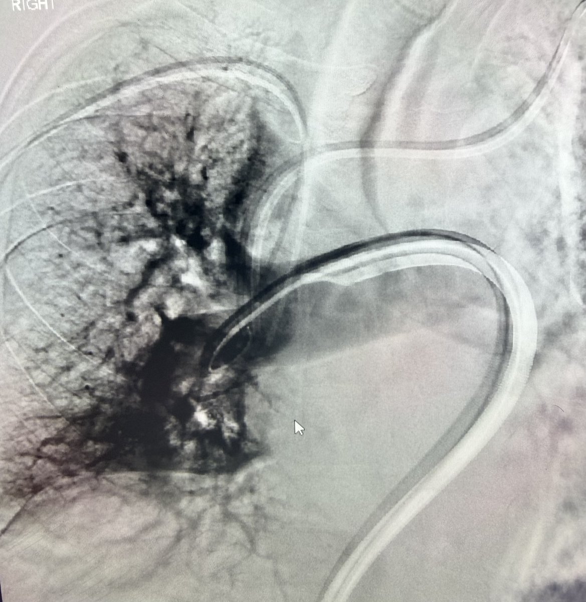 AustinBourgeois's tweet photo. PE Thrombectomy with the Inquis Aventus.  Some interesting design elements:  

Angular tip for directionality
Sensor to detect clot vs vessel wall
Integrated filtration system 
Integrated guide cath for selection 

no COI
#iRad https://t.co/eiCRxKzNWR