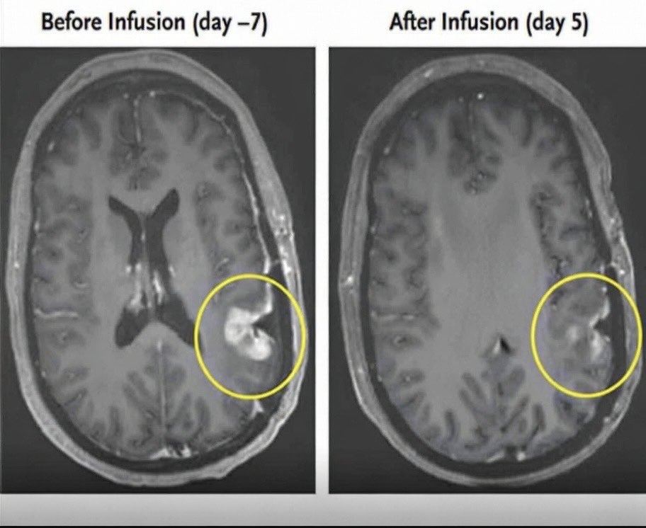 2StefanMoore's tweet image. A deadly glioblastoma that’s long defied treatment just showed extraordinary responses in a Mass General trial that’s giving hope for #BrainCancer 🧠 

Next-gen CAR-T therapy (dual-targeting EGFRvIII + wild-type EGFR) after one single infusion, all initial patients saw rapid…
