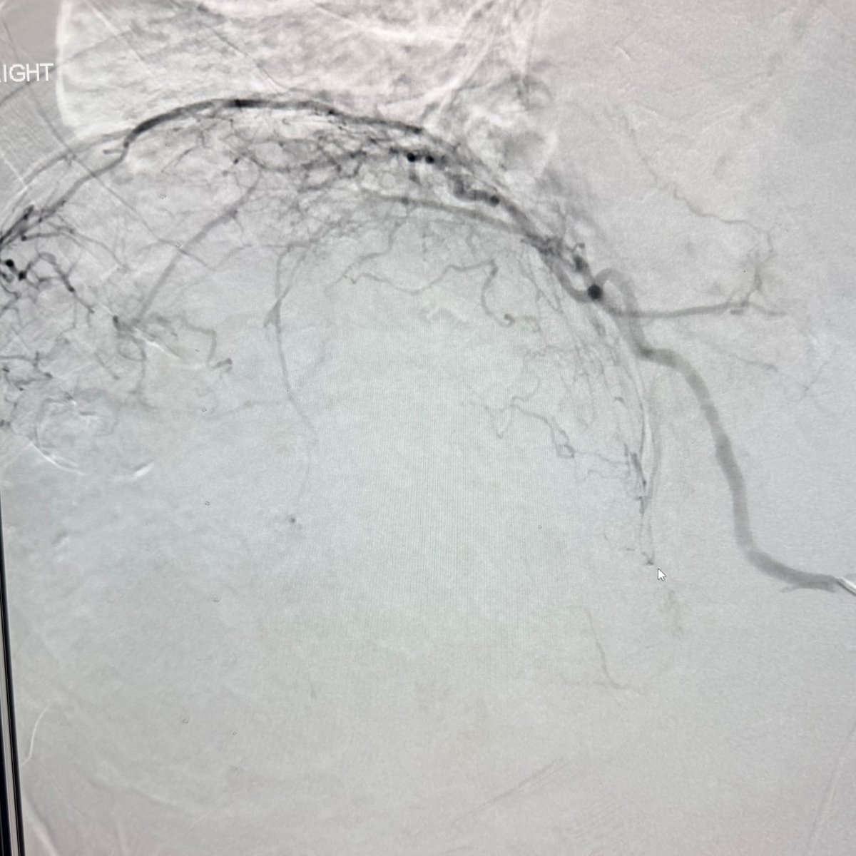 AustinBourgeois's tweet image. Perhaps the largest #HCC I've ever treated... 22cm!
Mapped for Y90 and consolidated vasculature.  Lung shunt was &amp;gt;40% so converted to TACE and systemic therapy.  #iRad