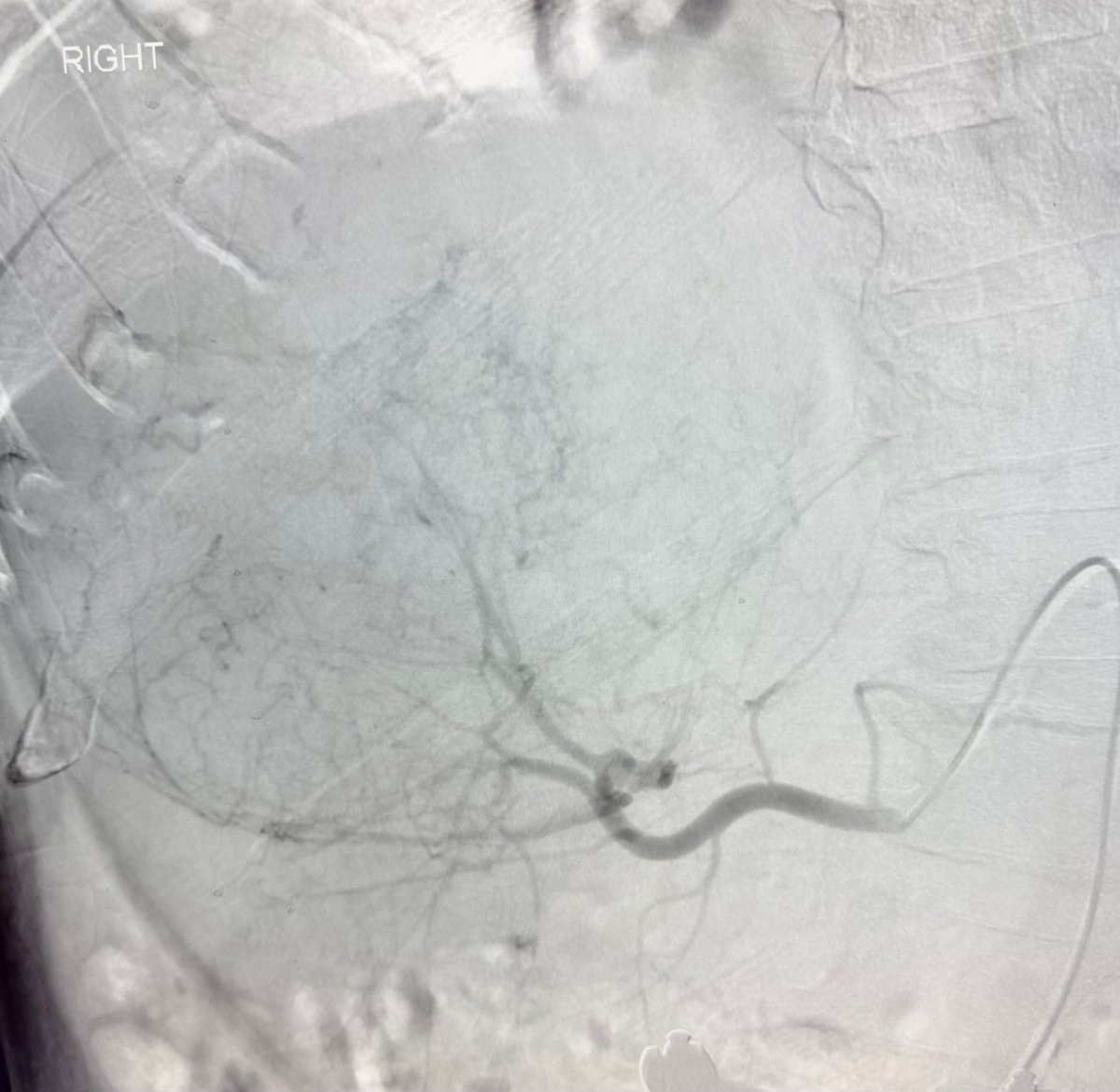 AustinBourgeois's tweet image. Perhaps the largest #HCC I've ever treated... 22cm!
Mapped for Y90 and consolidated vasculature.  Lung shunt was &amp;gt;40% so converted to TACE and systemic therapy.  #iRad
