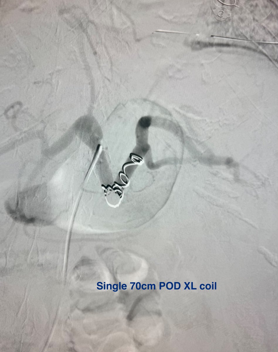 AustinBourgeois's tweet image. These POD XL coils have been nice to facilitate large vessel takedown like in BRTO/TIPS, pelvic trauma, or in 10mm splenic arteries like this one.   #iRad 

no COI
