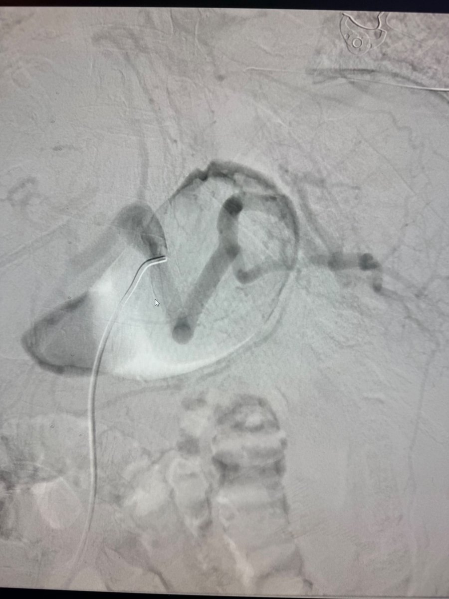 AustinBourgeois's tweet image. These POD XL coils have been nice to facilitate large vessel takedown like in BRTO/TIPS, pelvic trauma, or in 10mm splenic arteries like this one.   #iRad 

no COI