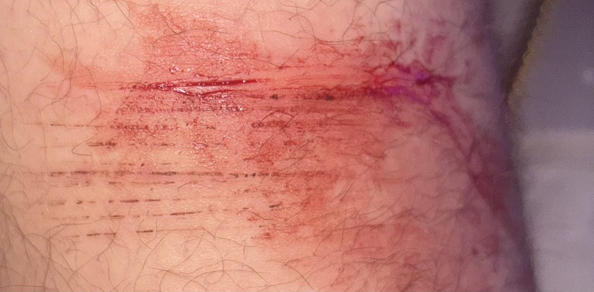 sleepydarkash's tweet photo. TW: SH. ALL FAKE AND ITS ALL MAKEUP

cute little cut i did on my thigh https://t.co/3h7VXhCHDg