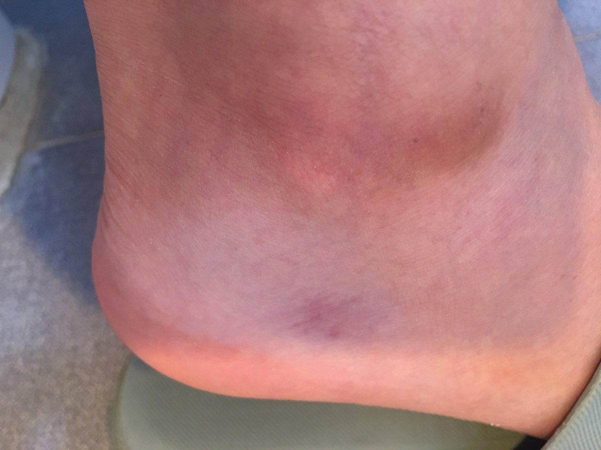 [야부] 울 남표니 또 ~~ ㅠㅠ (또르르~)
이번에는 계간에서 헛 디디며 굴렀다.
아~~다행히 계단 두개 남겨 놓은거라 머리나 가른 곳은 괜찮다.
헉 디뎌 삔 발목때문에 멍이 들고 잘 못 걷네.
짚었던 손은 손바닥이 멍이 들고…
밤새 냉찜질과 적외선하고 부목대고 하루 지나니 좀 나았네
25년이 수난임